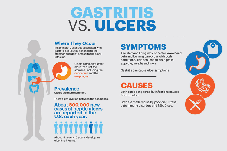 Gastritis vs. Ulcer