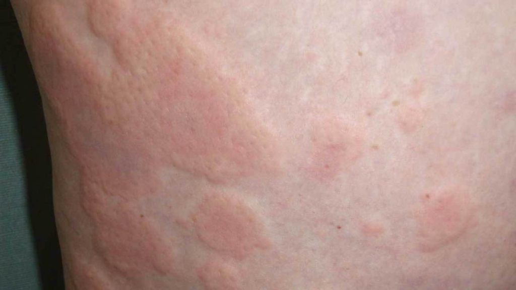 Natural Treatment for Hives