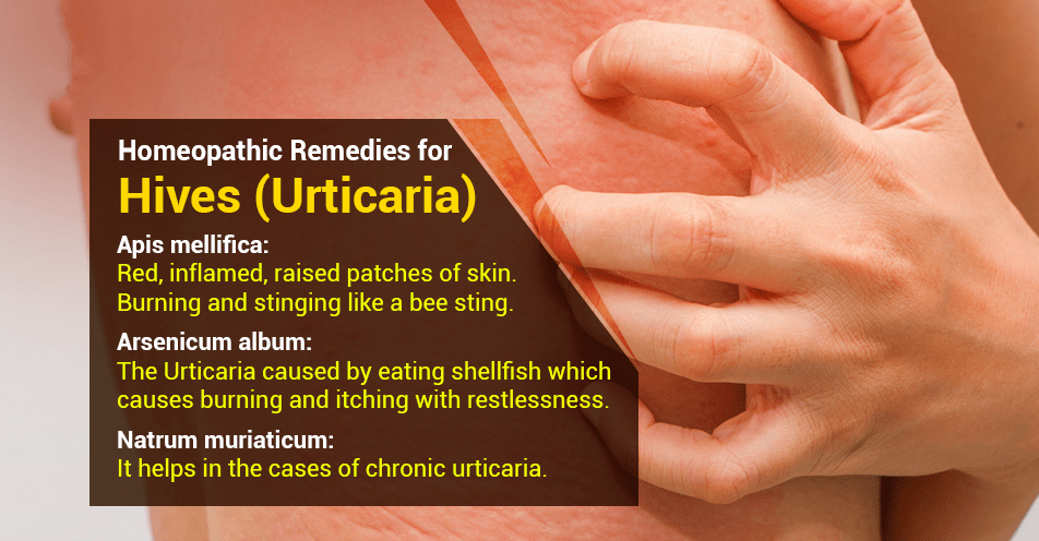 Homeopathic remedies for Urticaria