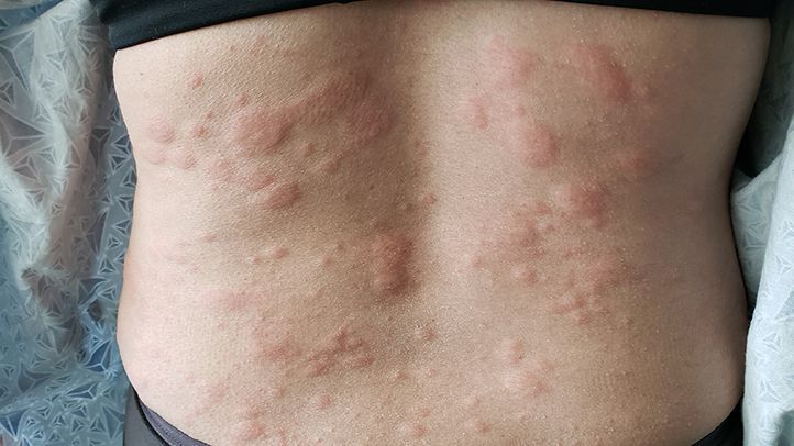 Symptoms of hives