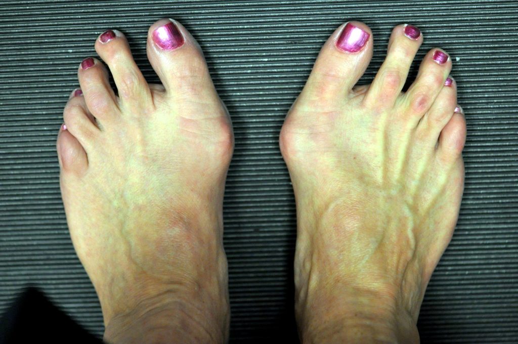 Homeopathy cures bunions