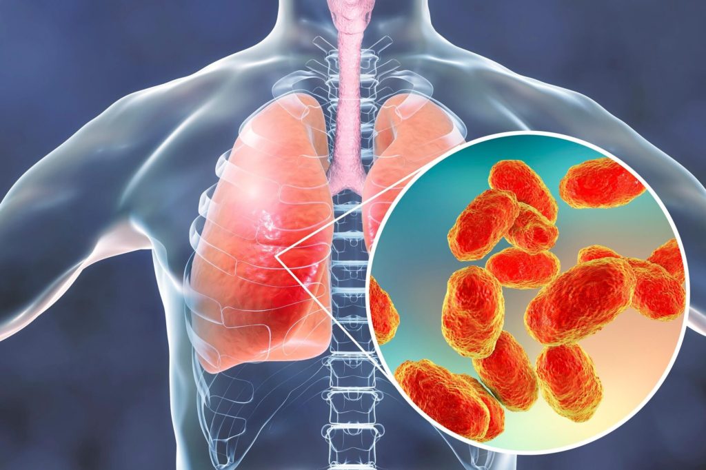 Pneumonia