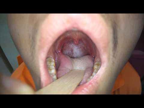 post nasal drip throat