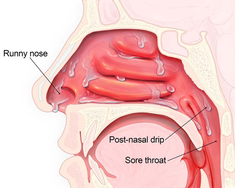 Symptoms of post-nasal drip