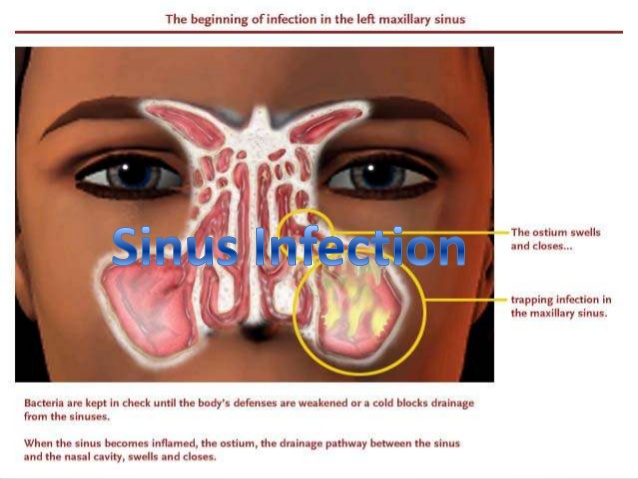 Sinusitis