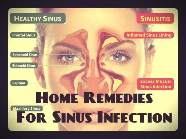 Home remedies for sinusitis