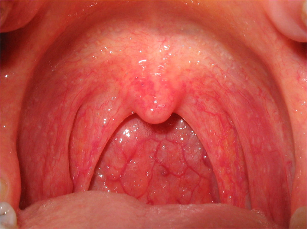 Symptoms of sore throat