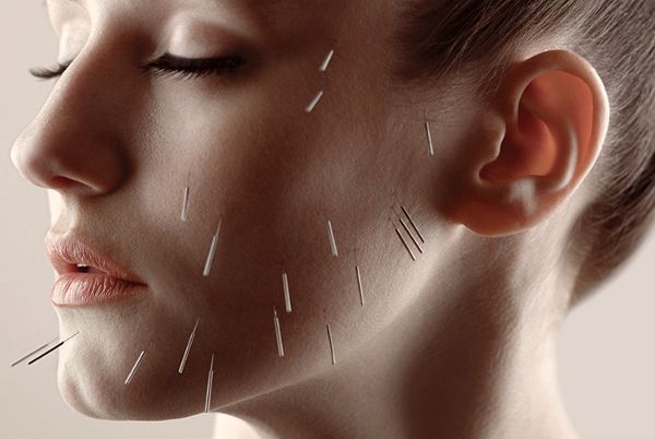 Acupuncture for TMJ