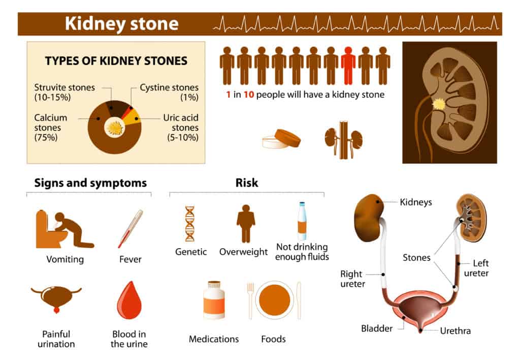 Kidney stones signs and risk factors