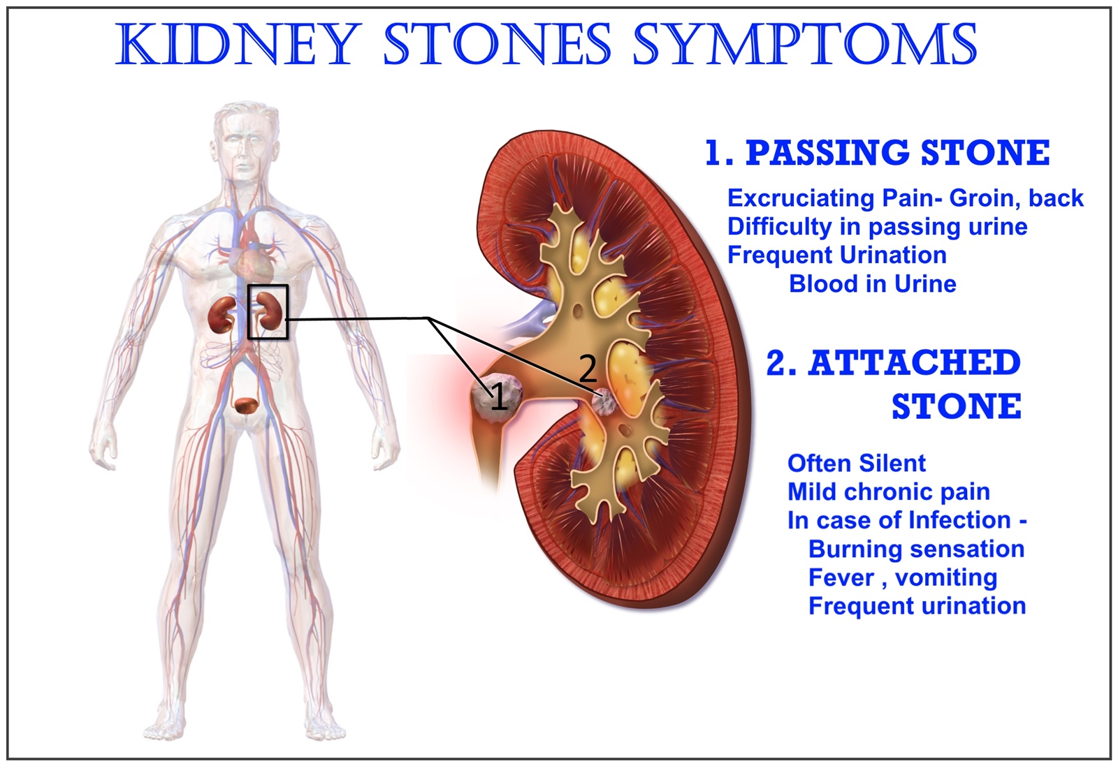 Symptoms of nephrolith