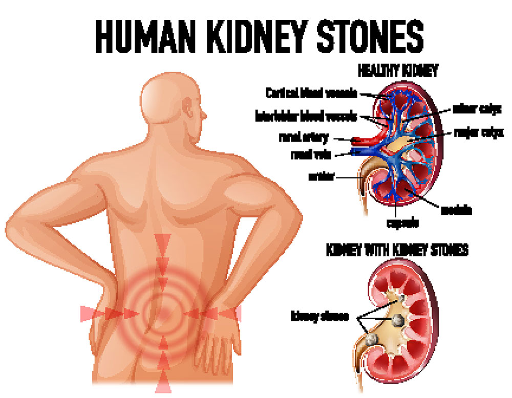 Renal calculus