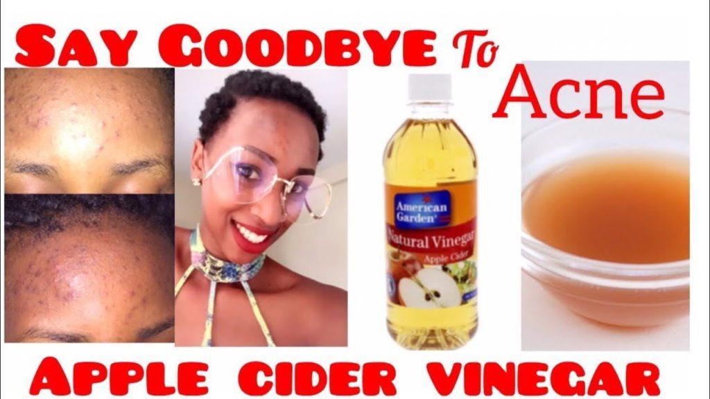 ACV for Acne