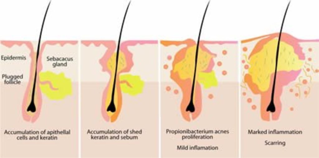 What is causing acne