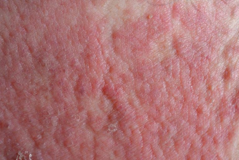 Red Spots on the Skin Philadelphia Holistic Clinic Dr. Tsan & Assoc.