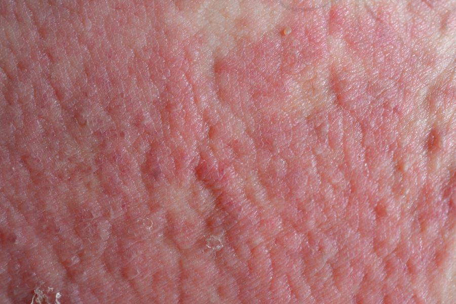 Atopic-dermatitis