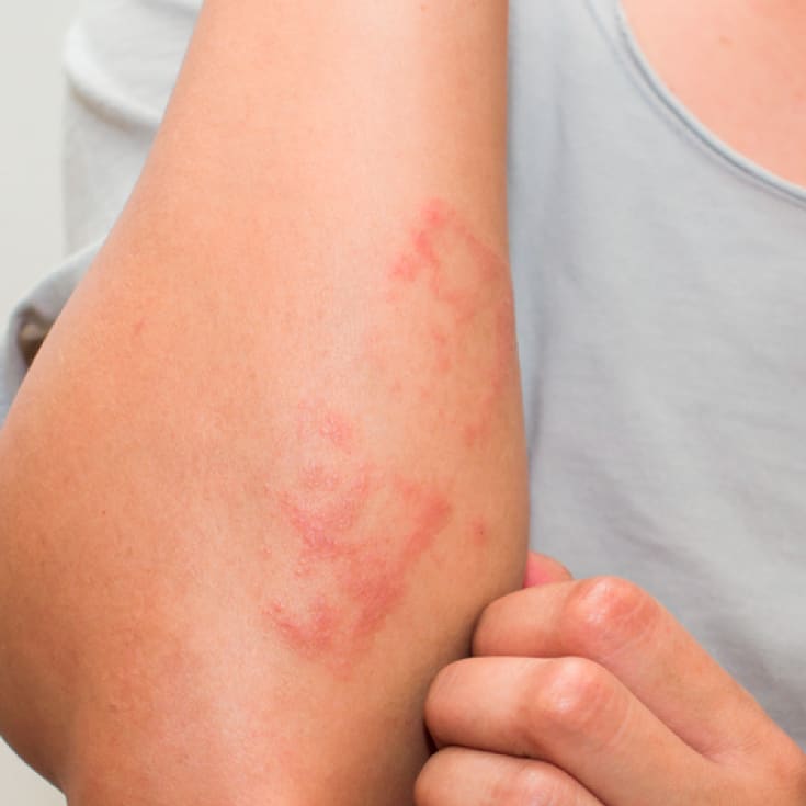 Contact dermatitis - most common condition that causes red spots on the skin