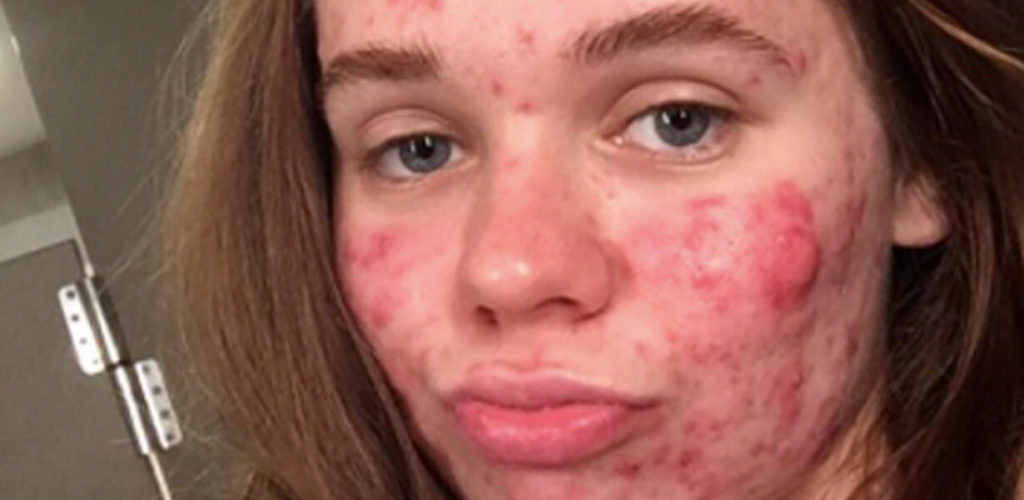 Cystic Acne