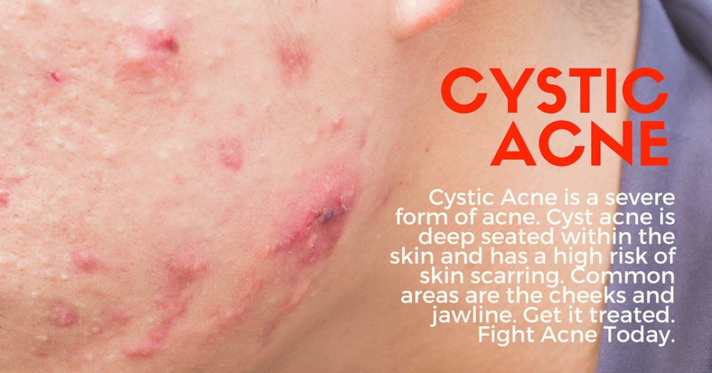 Cystic Acne