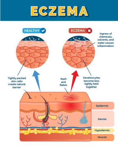 Atopic Dermatitis