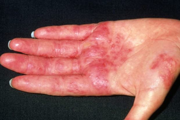 Treatment for eczema on hands