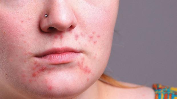 Hormonal Acne