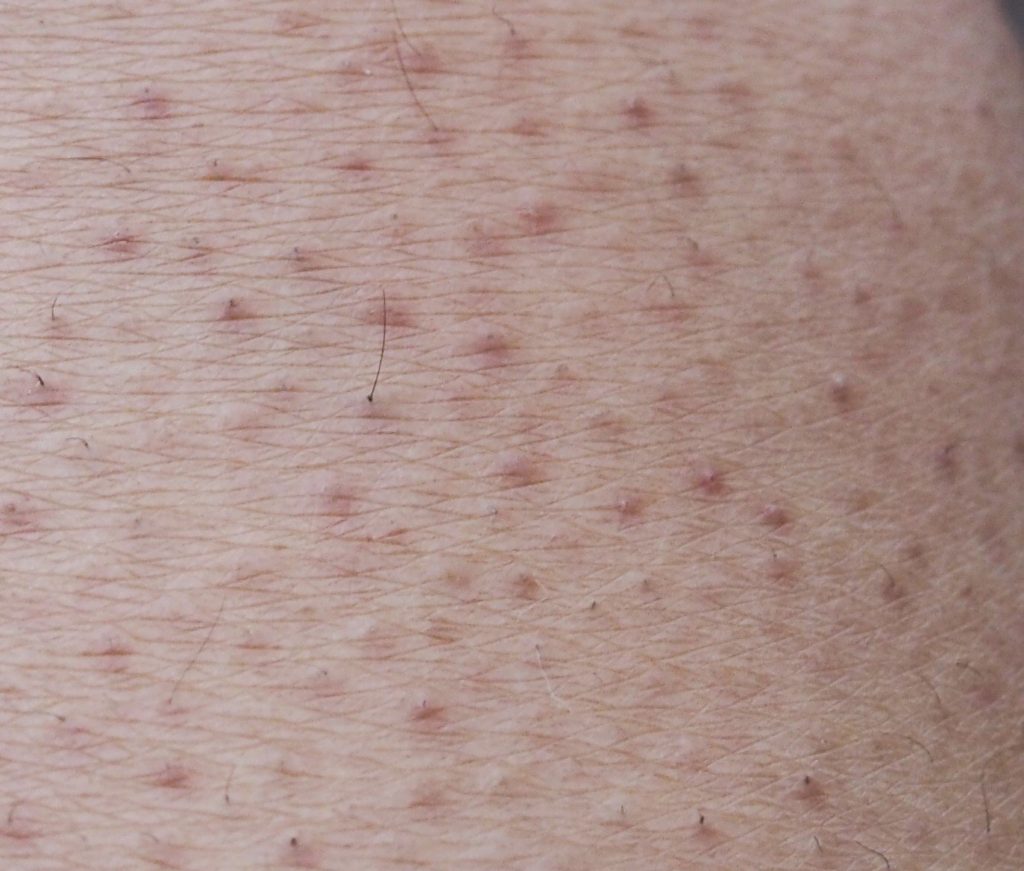 Keratosis pilaris