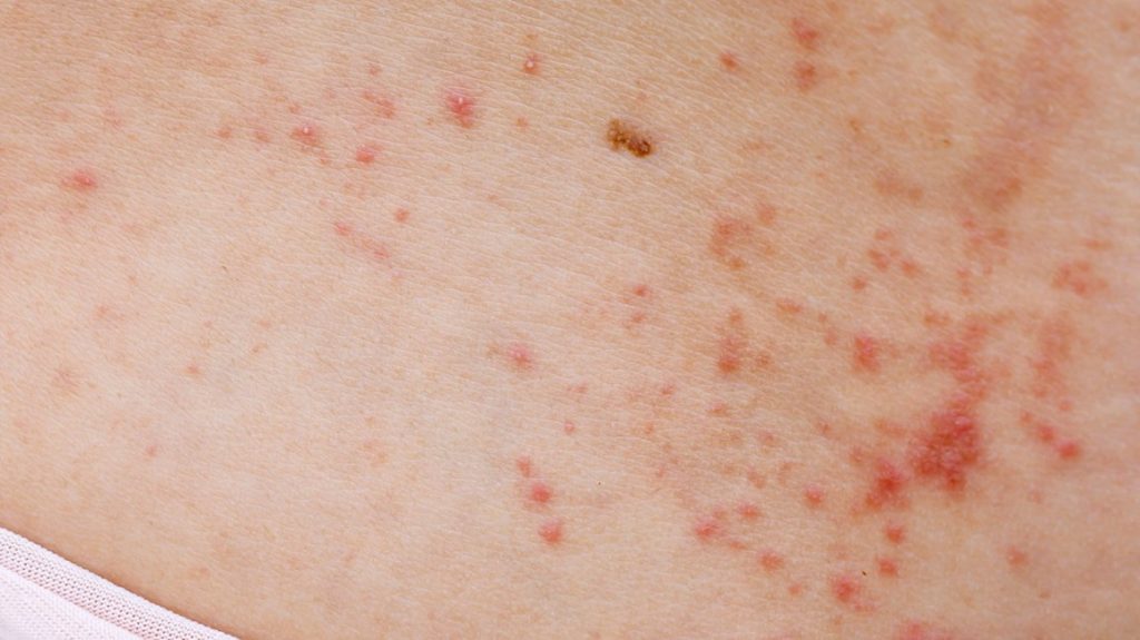 Red spots on the skin