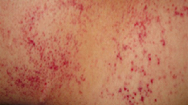 Red spots on the skin