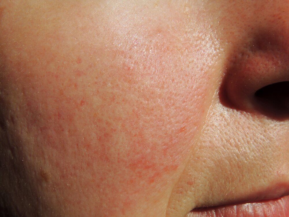 Rosacea causes red spots on the skin