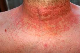 Scarlet fever - red spots on the skin with red background