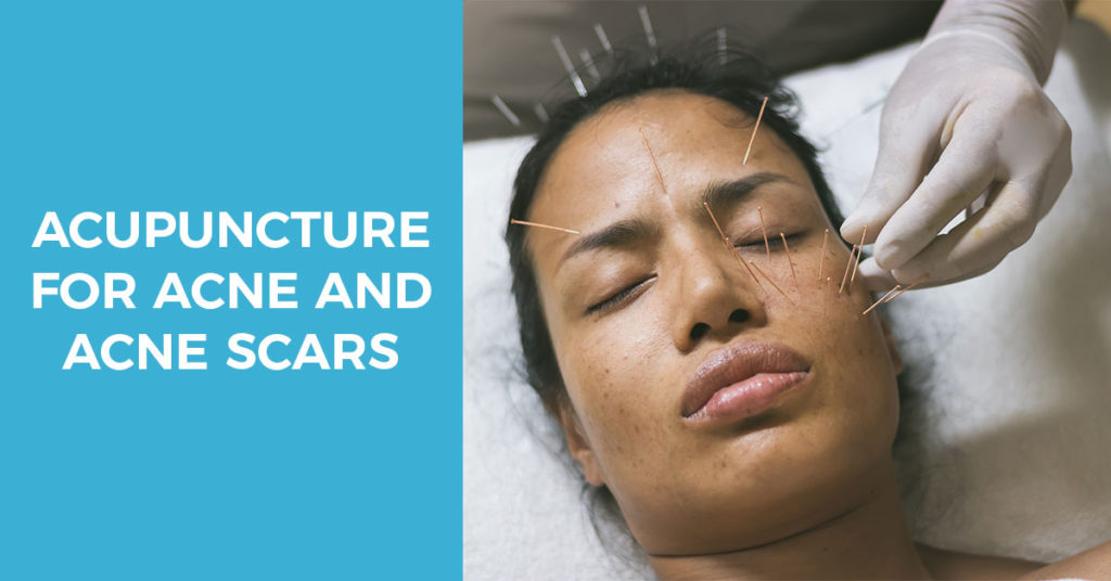 Acupuncture for Cystic Acne