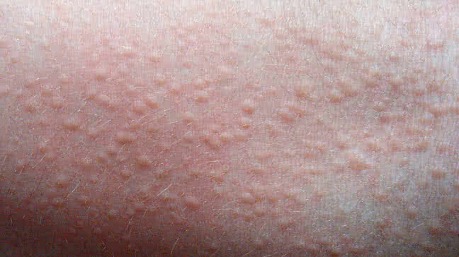 Heat rush may cause red spots on the skin