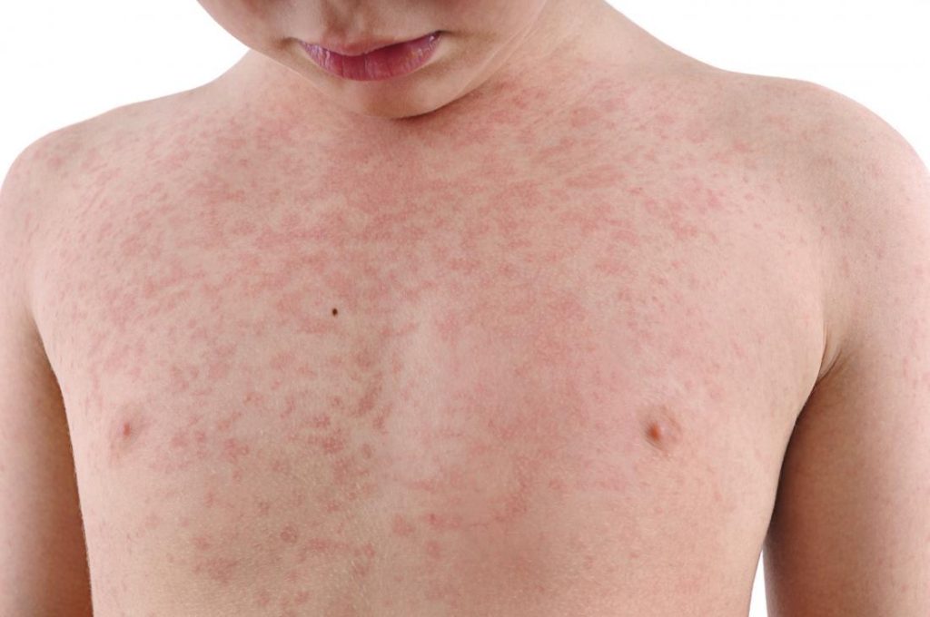 red spots on the skin - symptom of rubella