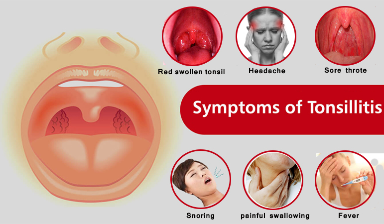 6 symptoms of tonsillitis