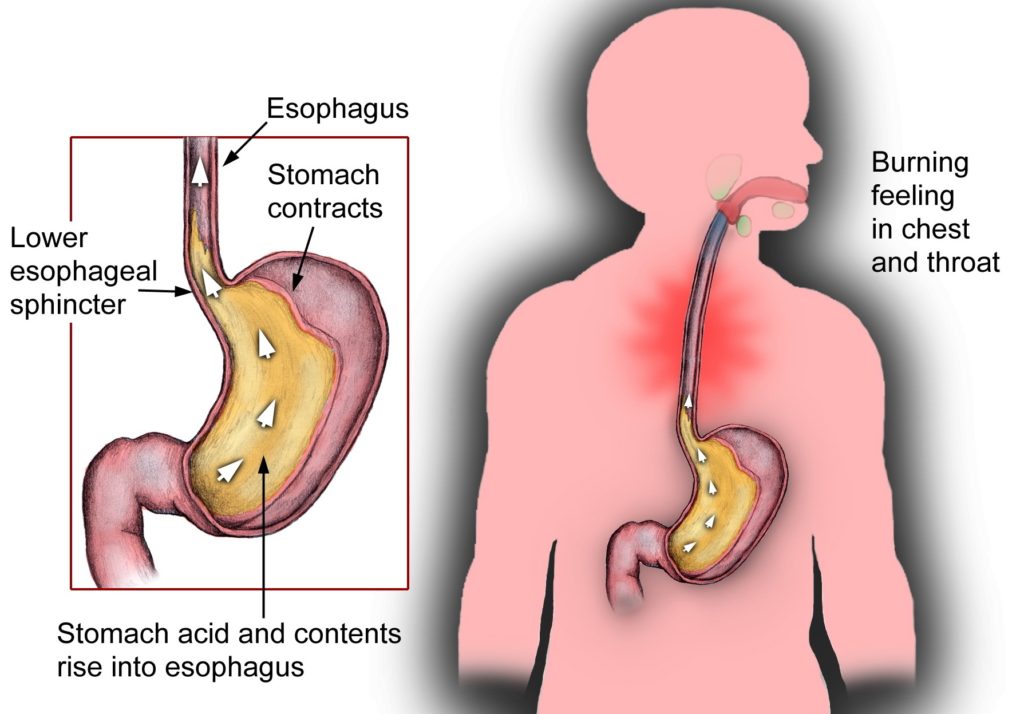 Acid reflux causing severe heartburn