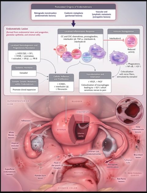 Treatment For Endometriosis Philadelphia Holistic Clinic Dr Tsan And Co 6179