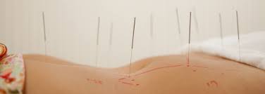 Acupuncture