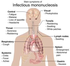 Symptoms of mononucleosis