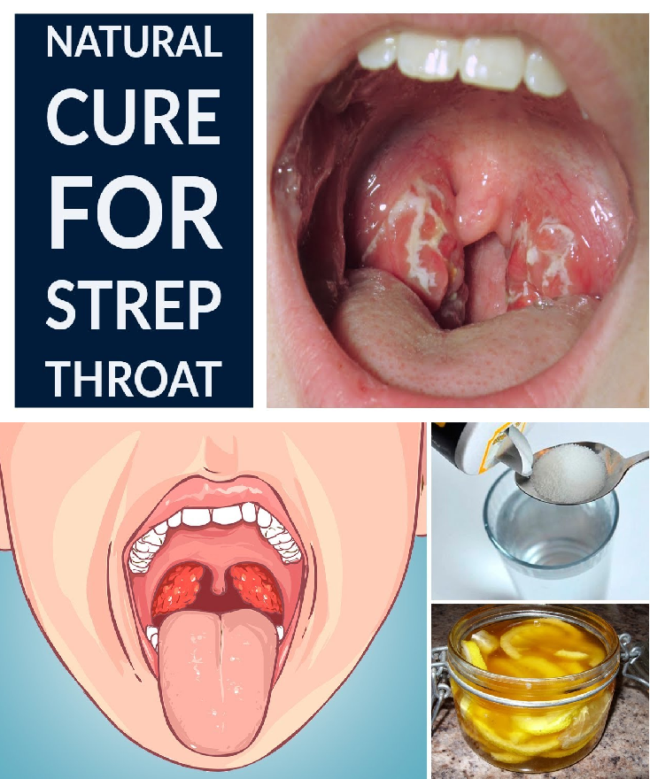 Strep Throat Natural Cure 