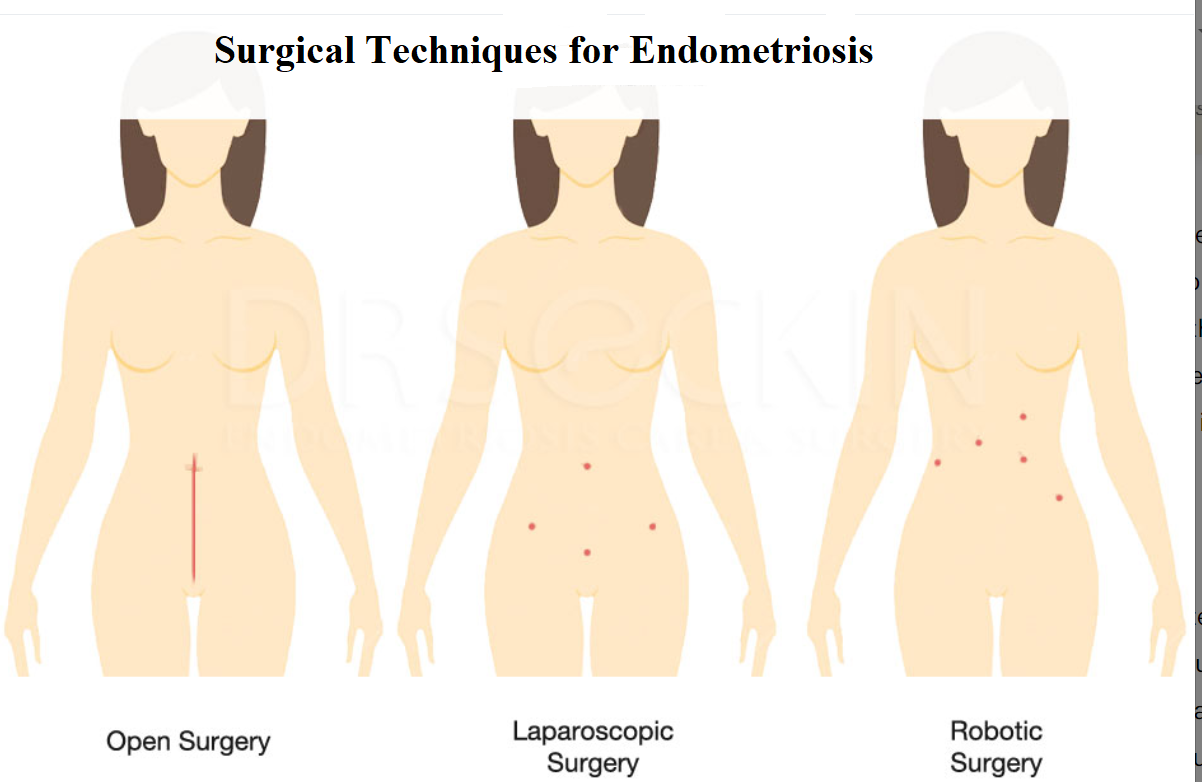 Surgery techniques for gynecological conditions