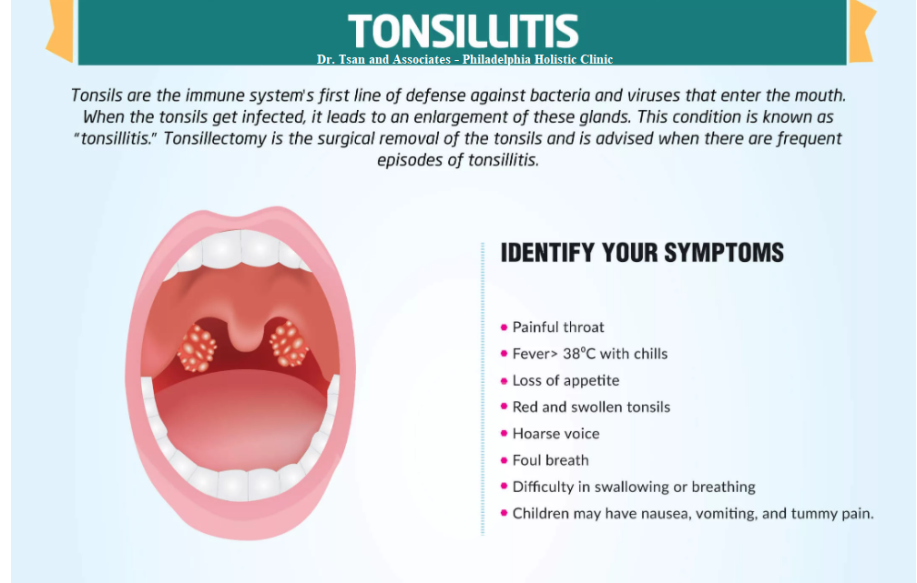 Symptoms Of Tonsil Cancer