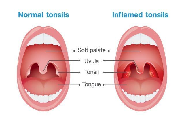 Normal and inflamed tonsils