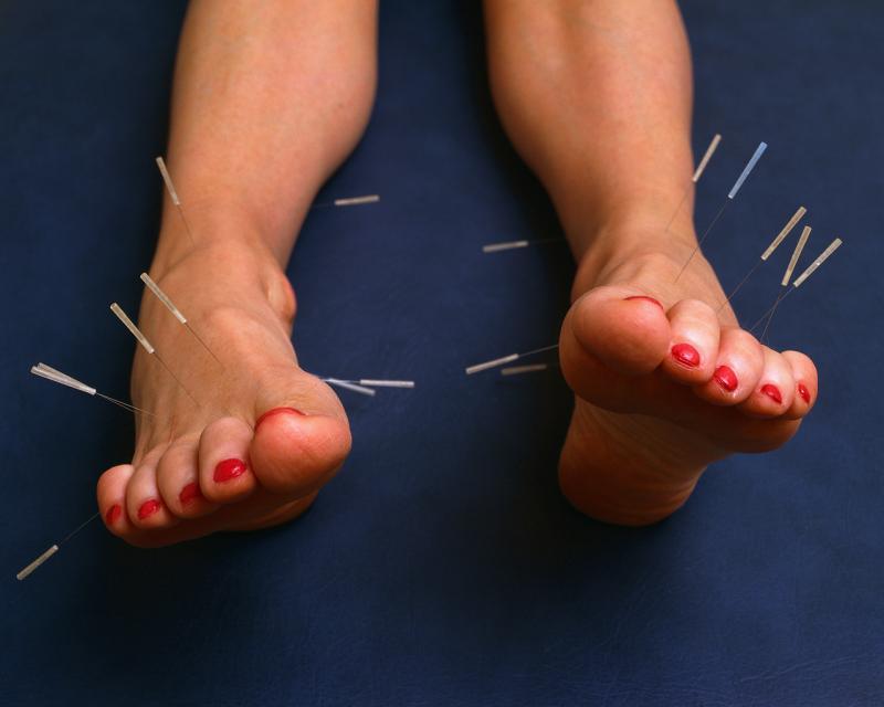 Acupuncture for plantar fasciitis