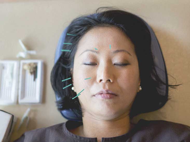 Relief from Migraine with Acupuncture