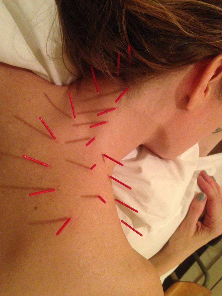Neck Pain Acupuncture