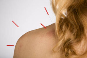 Acupuncture treatment for neck pain