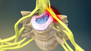 Neck pain symptoms