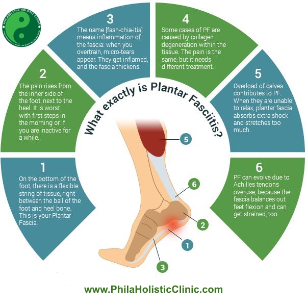 All about plantar fasciitis