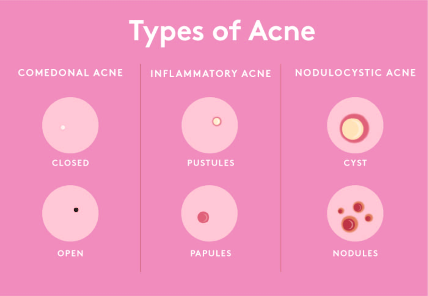 Acne types