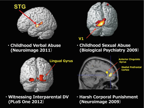 Corporal punishment affecting brain